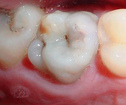 Dişin fissür bölgesinde siyah noktalar bazen iç çürük boşluğa yol açar.