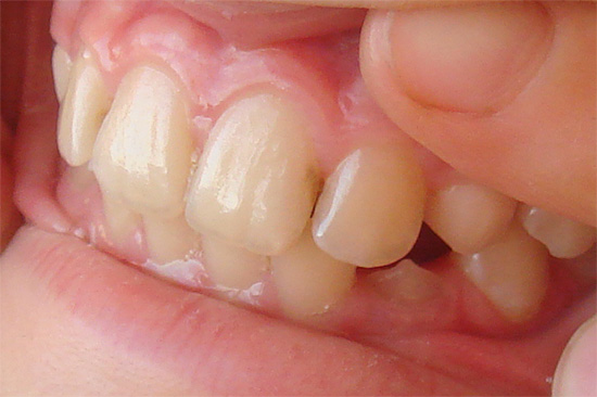 Tổn thương nghiêm trọng bên trong không gian kẽ răng (sâu răng sâu)