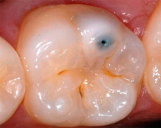 Manchmal mit minimalen äußeren Manifestationen kann chronische Karies zur allmählichen Bildung von umfangreichen kariösen Hohlräumen im Dentin unter dem Zahnschmelz führen.
