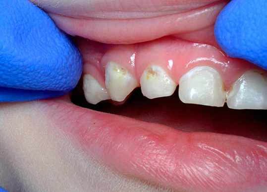In most cases, the presence of chronic caries is established with a simple visual inspection.