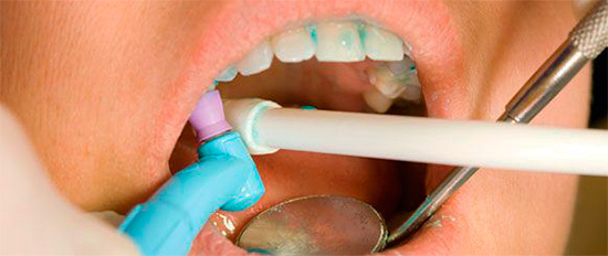 Con un danno superficiale ai denti, la terapia rimineralizzante è spesso sufficiente per ripristinare le proprietà dello smalto dei denti.