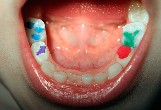 Användningen av färgade fyllningar gör tandbehandling som ett spel, vilket gör att hela proceduren blir mindre skrämmande för ett barn.