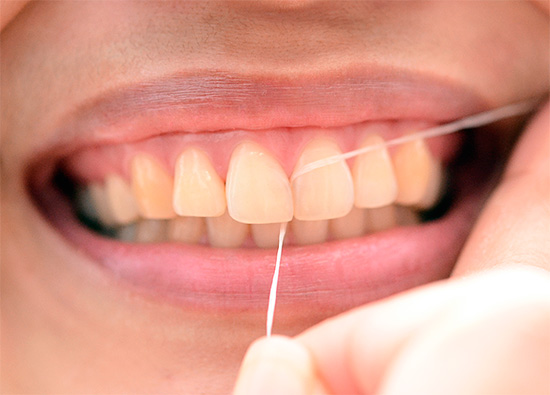 Die Verwendung von Zahnseide ermöglicht eine effektive Reinigung der Interdentalräume, wo Karies auch versteckt verborgen werden kann.