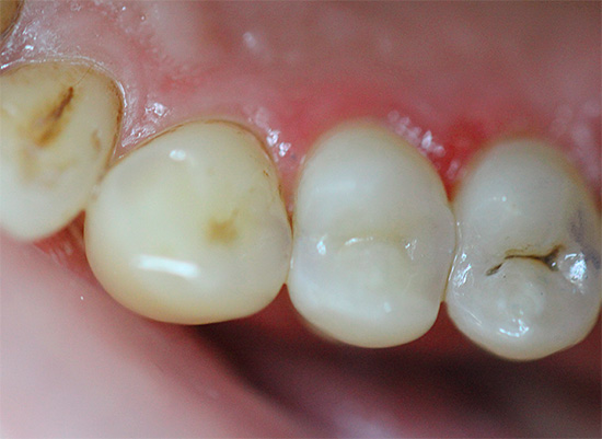 Small marks of caries on the teeth are often taken for granted.