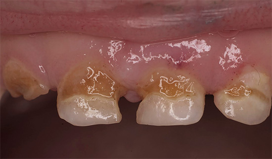 विशेष रूप से शिशु दांतों पर पुरानी क्षरण, आसानी से एक तीव्र रूप में बदल सकती है, जिसमें तामचीनी और दंत चिकित्सा के बहुत तेज़ विनाश की विशेषता होती है।