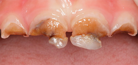 A foto mostra um exemplo de dentes de leite, quase completamente destruídos pelo processo carioso agudo.