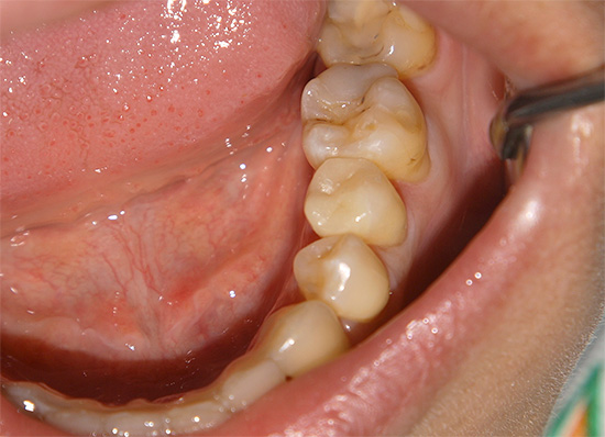 Någonting som detta kan se ut som tänder i kroniska karies - det finns flera mindre spår av lesioner, vanligtvis stör inte personen.
