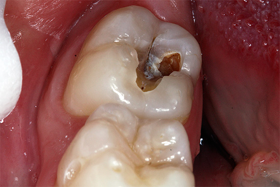 Even with deep caries, with the chronic form of its development, pain can be minimal.