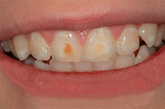 Múltiplos focos de cáries iniciais são visíveis nos dentes - manchas brancas no esmalte, às vezes já pigmentadas.