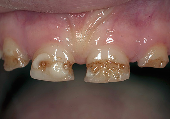 Considérez les caractéristiques de la forme négligée de la carie, lorsque presque chaque dent peut avoir de multiples traces de destruction ...