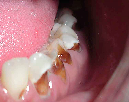 Sâu răng tổng quát có thể được quan sát không chỉ ở trẻ em, mà còn ở người lớn.