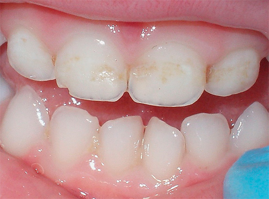 Vid de första tecknen på demineralisering av tandemaljen är det nödvändigt att vända sig till en tandläkare, vilket gör att processen inte blir akut.