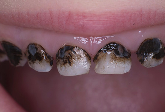 Fotoğraf gümüş kaplı dişlerin bir örneğini göstermektedir (ancak, bu prosedür her zaman çürüklerden korunmaz)