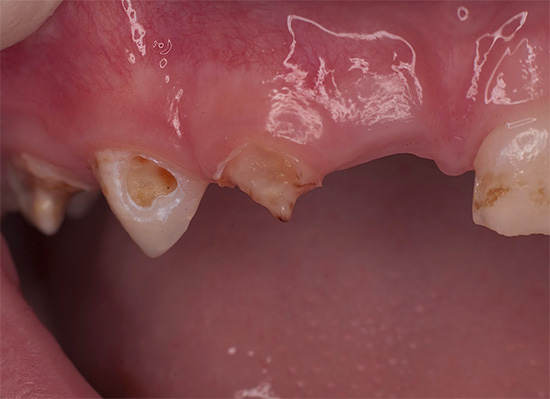 ฟันผุทั่วไปเกือบทุกซี่มีร่องรอยของรอยโรค