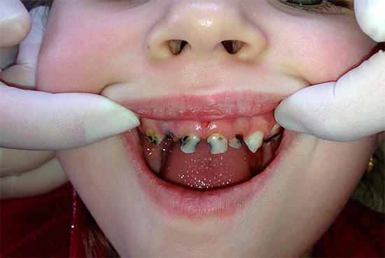 एक बच्चे में सभी दांत क्षय से प्रभावित होते हैं।