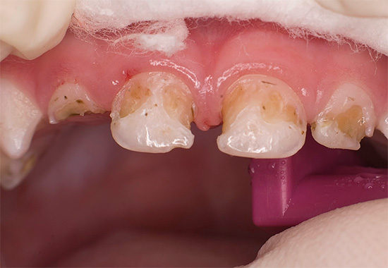 With the running form of the disease, severe pain can occur, and in many teeth at once.