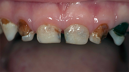 An example of generalized caries of milk teeth in a child.