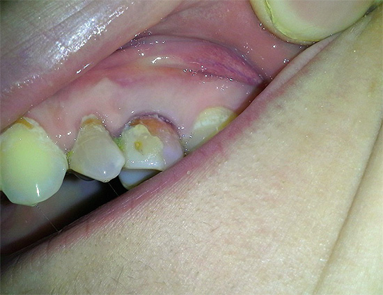 Trong một nỗ lực để chữa bệnh sâu răng bằng hydrogen peroxide, chỉ có răng không đồng đều có thể đạt được, và bỏng của niêm mạc miệng cũng có khả năng.