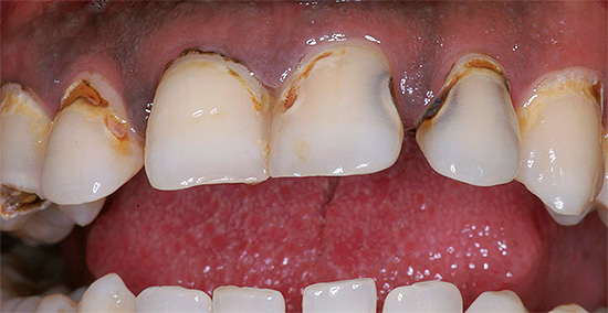 Strangely enough, but plots sometimes seem to reduce toothache, but the caries itself does not go anywhere, and in the future problems will only increase.