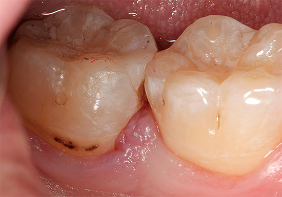 Si les dents sont clairement en mauvais état, ne retardez pas la visite chez le dentiste, car à la maison, vous ne pourrez pas vous en débarrasser.