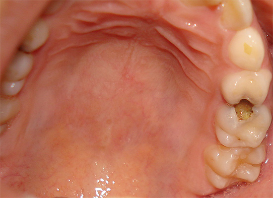 The photo shows an example of deep caries, when home treatment will be completely ineffective.