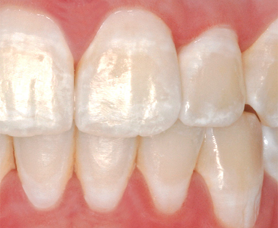 Bức ảnh cho thấy một ví dụ về sâu răng trong giai đoạn của cái gọi là đốm trắng (đôi khi còn được gọi là phấn)