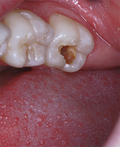 Çoğu durumda, dişin üzerindeki karanlık bölgeleri kazımaya çalışırken, çürük boşluk sadece derinleşir ve komplikasyon riski artar.