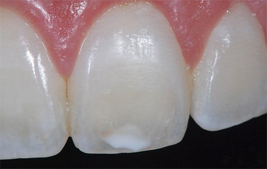 Mas no estágio de manchas brancas para restaurar as propriedades do esmalte dentário é bastante possível, não só no dentista, mas também em casa.