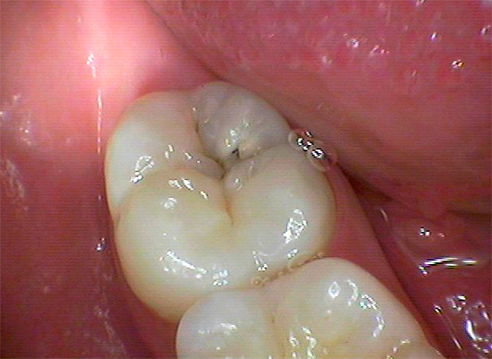 Zelfs onbetekenende donkere punten op het kauwvlak van de tand (in het spleetgebied) zijn soms een soort inham van diepe carieuze holtes die doordringen tot in de dentinelaag ...