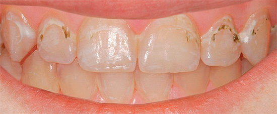 Leider gibt es keine Garantie dafür, dass Sie sich selbst behandeln und Ihre Zähne wieder normalisieren können.