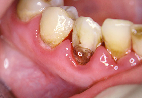 Các biện pháp dân gian, tất nhiên, sẽ không chữa được sâu răng cổ tử cung, nhưng sẽ giúp giảm đau khi bị tổn thương nặng.