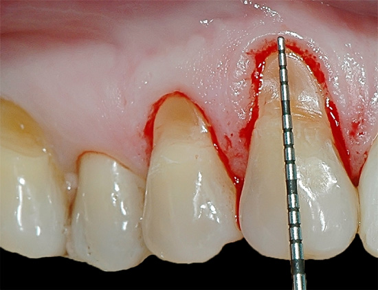 Een van de problemen bij de behandeling van cervicale defecten is het binnendringen van bloed van het tandvlees in het werkveld.