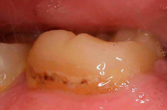 Het lijkt op een tand met cervicale cariës vóór de behandeling