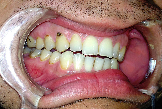 The photo shows an example of cervical caries on the upper tooth.