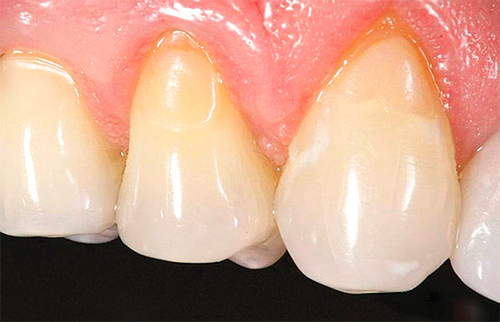 Servikal çürük tedavisi sonrası dişler - farkedilir dolgular