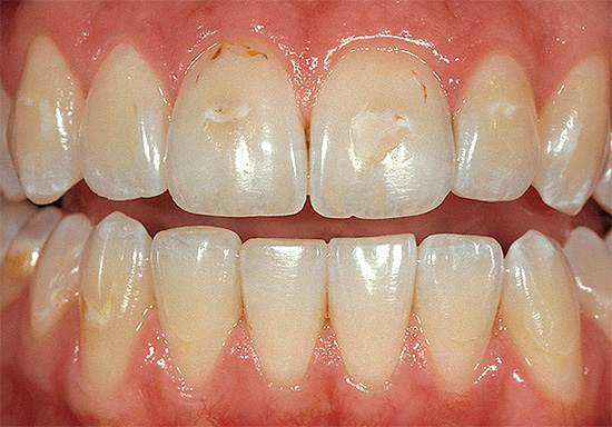 ในขั้นเริ่มต้นของการพัฒนาของโรคฟันผุของปากมดลูกสามารถนำไปสู่การก่อตัวของจุดสีขาวซึ่งจะค่อยๆสี