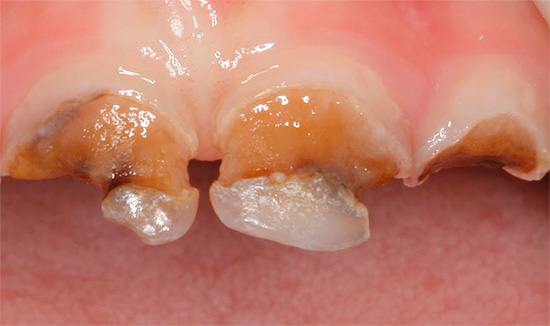 Com cáries circulares profundas, é possível romper a parte coronal do dente.