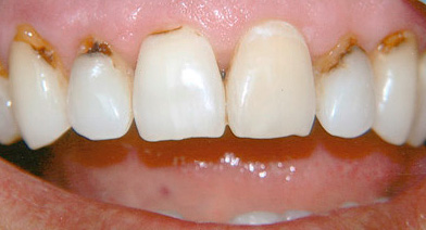 Bất kỳ khuyết tật nào trên răng trước, chưa kể đến sâu răng cổ tử cung, làm hỏng đáng kể sự xuất hiện của khu vực nụ cười.
