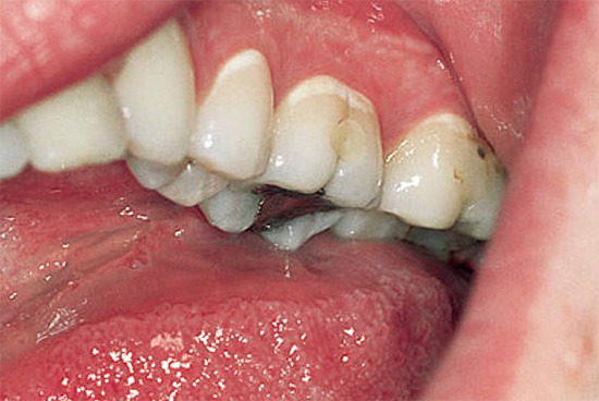 Снимката показва белите зони на деминерализирания емайл в зоната на чакане на няколко зъба наведнъж.