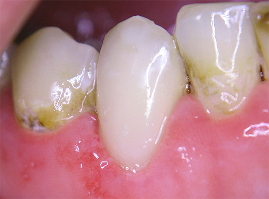 An example of superficial cervical caries.