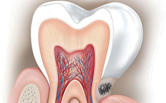 Trong một số trường hợp, việc điều trị sâu răng cổ tử cung ở nhà thông qua việc sử dụng các chất khử khoáng có thể có tác dụng tích cực, nhưng chỉ ở giai đoạn đầu của quá trình bệnh lý.
