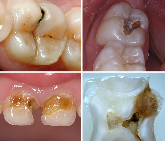 Låt oss se hur olika karies kan se ut, från början av dess utveckling och sluta med allvarliga kariesläsningar av flera tänder på en gång.