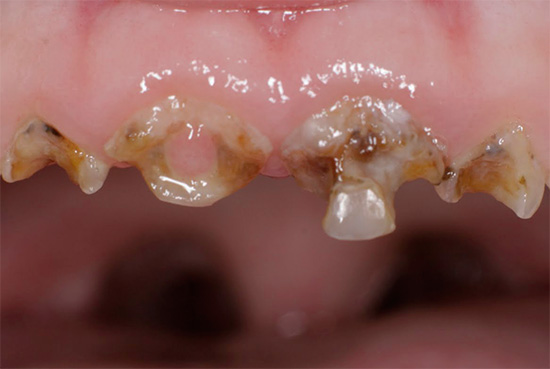 Sâu răng tổng quát của răng sữa trong một đứa trẻ.