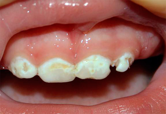 Ένα άλλο παράδειγμα τερηδόνας σε ένα παιδί: αν δεν ξεκινήσετε την οδοντιατρική θεραπεία εγκαίρως, μπορεί να καταστραφεί σχεδόν εντελώς σε σύντομο χρονικό διάστημα.