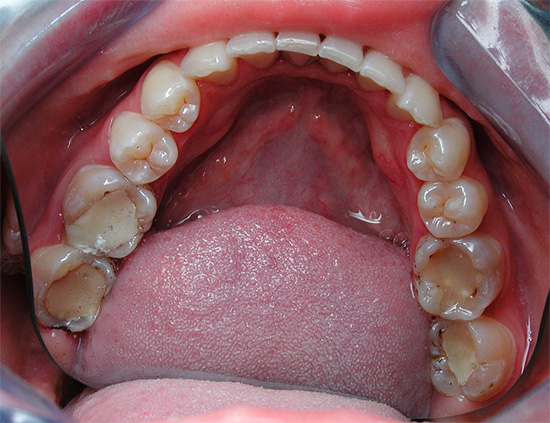 Caries can also develop under fillings, as well as in places of their adherence to the surrounding tooth tissues.