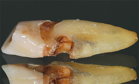 Cárie radicular, muitas vezes se desenvolvendo imperceptivelmente sob a gengiva, pode eventualmente resultar em perda do dente ou a necessidade de removê-lo.