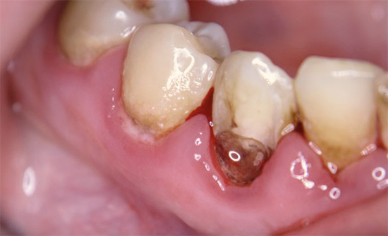 फोटो एक उदाहरण दिखाता है जहां दाँत के गर्भाशय ग्रीवा क्षेत्र क्षय से गंभीर रूप से प्रभावित होता है।