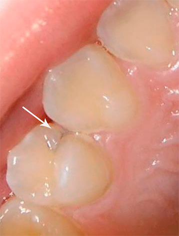 Interdental (aproximal) caries often proceeds in a latent form, visually without giving itself away.