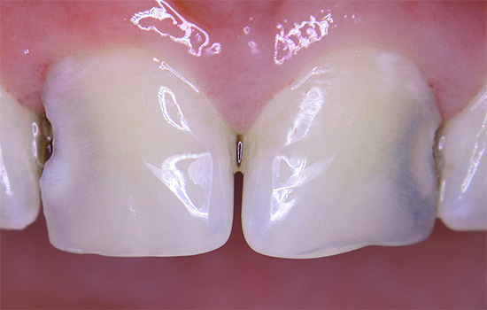 हालांकि, जैसे गुहा दांतों के बीच बढ़ता है, समस्या अंततः नग्न आंखों के लिए दिखाई देती है।