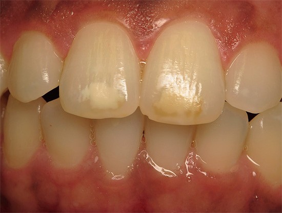 ในช่วงเริ่มต้นของการพัฒนาโรคฟันผุนำไปสู่ ​​demineralization ของเคลือบฟันเป็นผลจากการที่บางครั้งมันจะกลายเป็นสีขาวเคลือบและเริ่มที่จะมีสีด้วยสีย้อมอาหาร